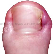 ayak parmakları hastalıkları